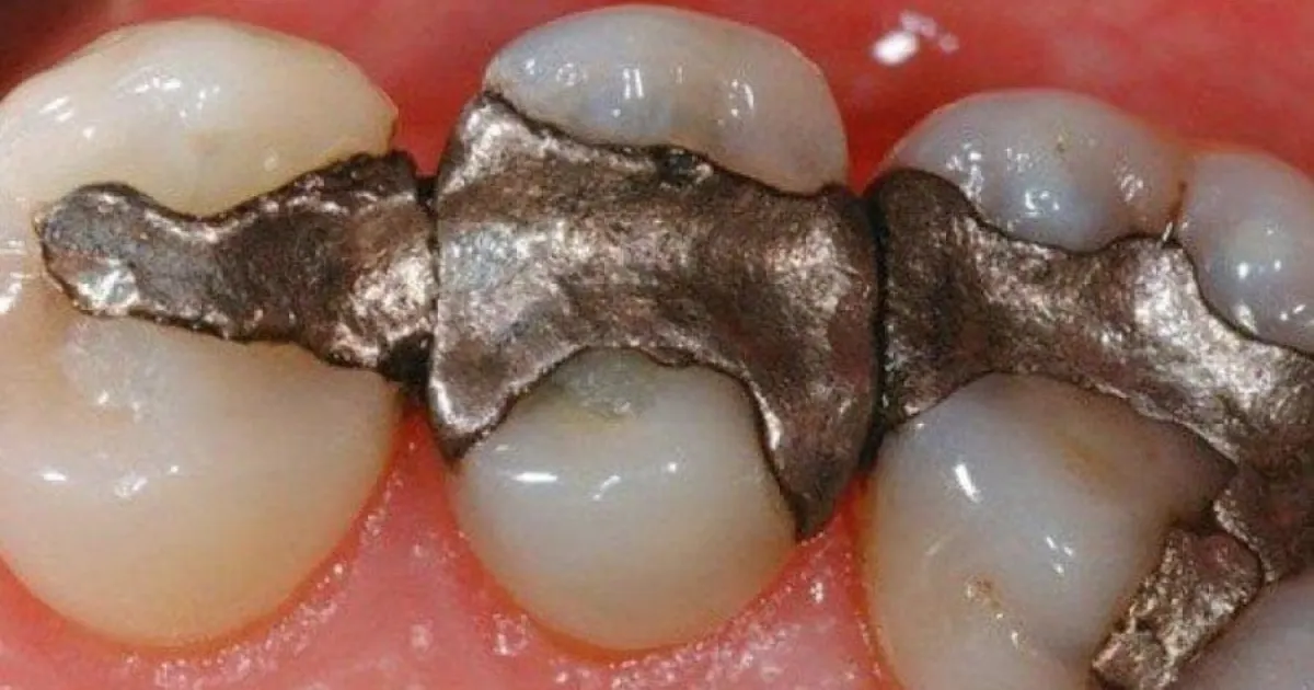Amalgam Filling Removal Why It's Critical to Your Health
