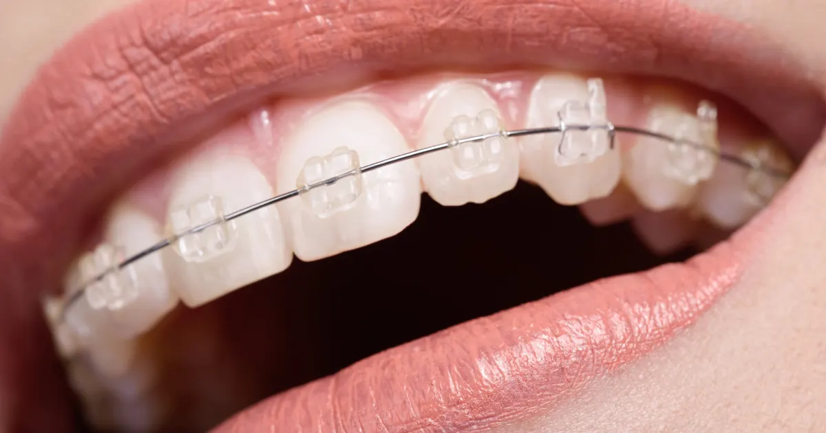 Alternatives to Braces for Teens